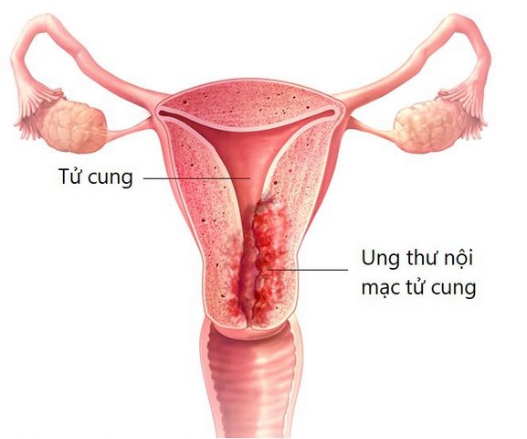 ung thư cổ tử cung là gì?