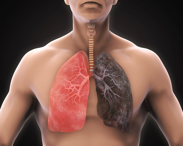 bênh ung thư phổi nguyên phát