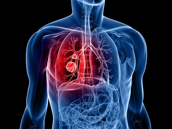 cách phát hiện ung thư phổi