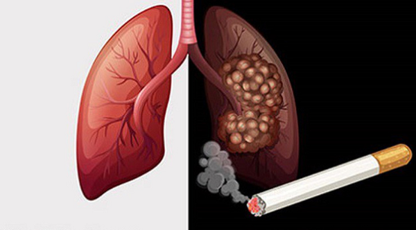 những biểu hiện của bệnh ung thư phổi