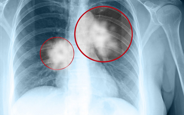 ung thư màng phổi giai đoạn cuối
